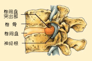 椎間盤(pán)突出示意圖